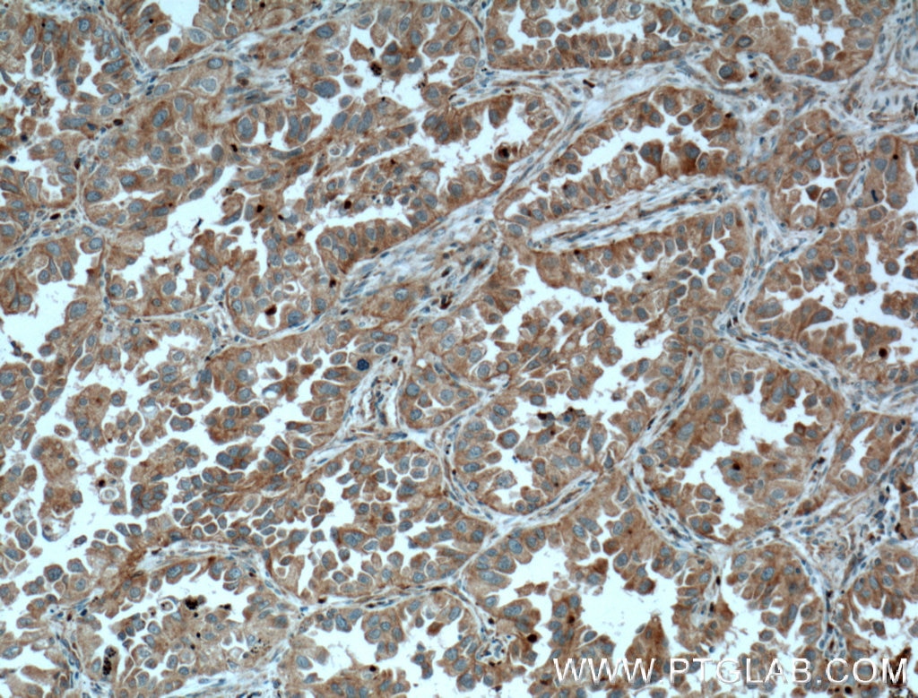 Immunohistochemistry (IHC) staining of human lung cancer tissue using RHOD Polyclonal antibody (11717-1-AP)