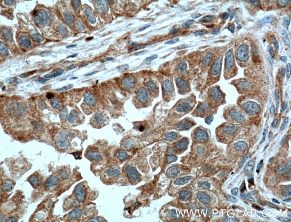 Immunohistochemistry (IHC) staining of human lung cancer tissue using RHOD Polyclonal antibody (11717-1-AP)