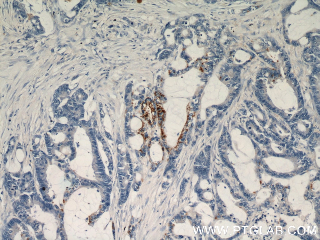 Immunohistochemistry (IHC) staining of human colon cancer tissue using RHOF Polyclonal antibody (12290-1-AP)