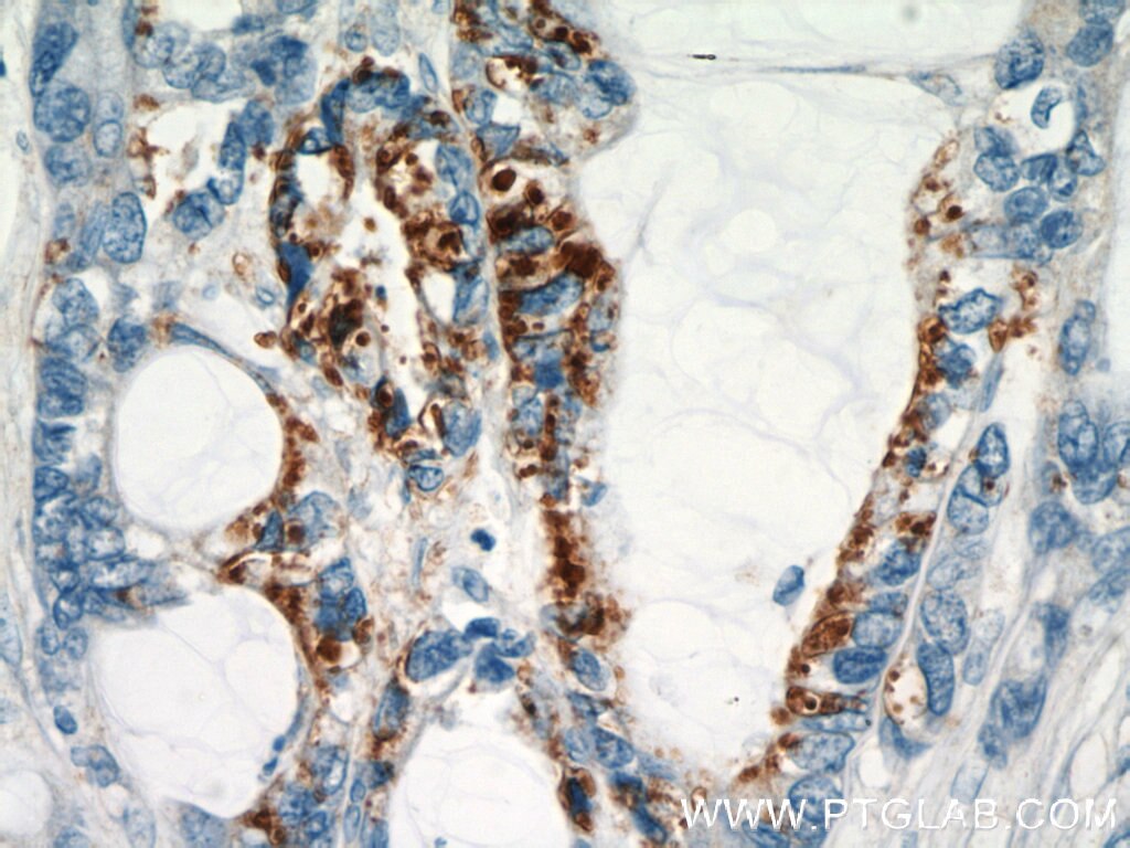 Immunohistochemistry (IHC) staining of human colon cancer tissue using RHOF Polyclonal antibody (12290-1-AP)