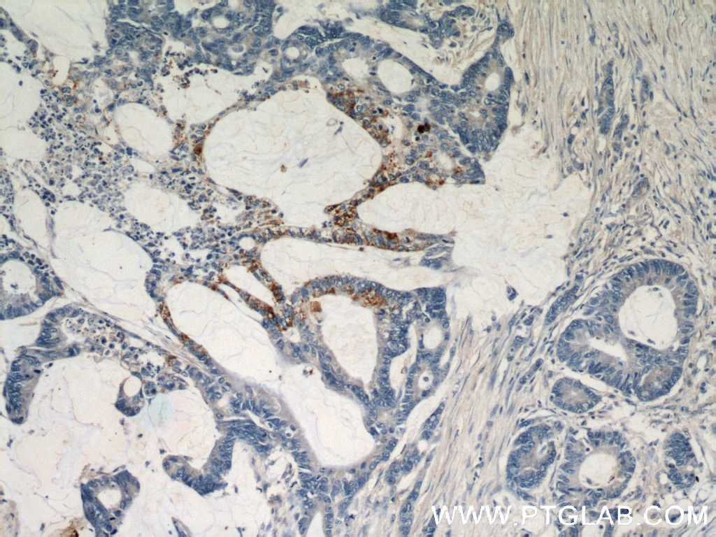 Immunohistochemistry (IHC) staining of human colon cancer tissue using RHOF Polyclonal antibody (12290-1-AP)