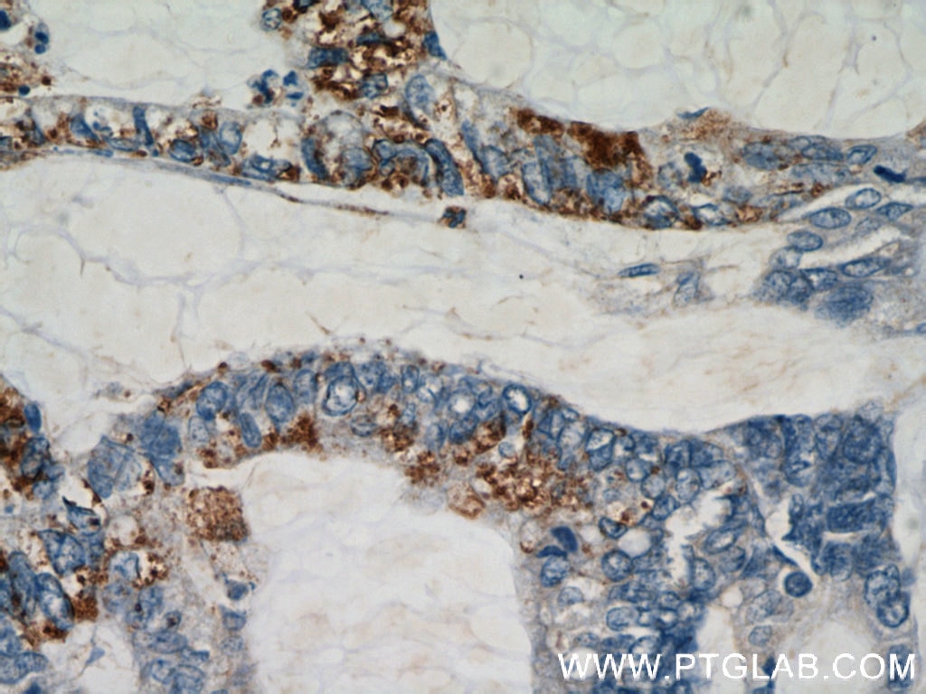 Immunohistochemistry (IHC) staining of human colon cancer tissue using RHOF Polyclonal antibody (12290-1-AP)