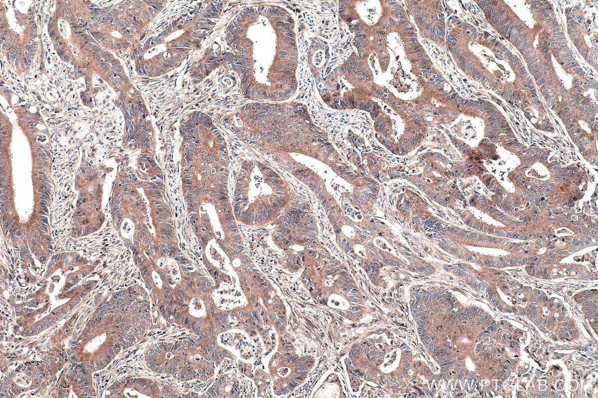 Immunohistochemistry (IHC) staining of human colon cancer tissue using RHOQ/TC10 Monoclonal antibody (67213-1-Ig)