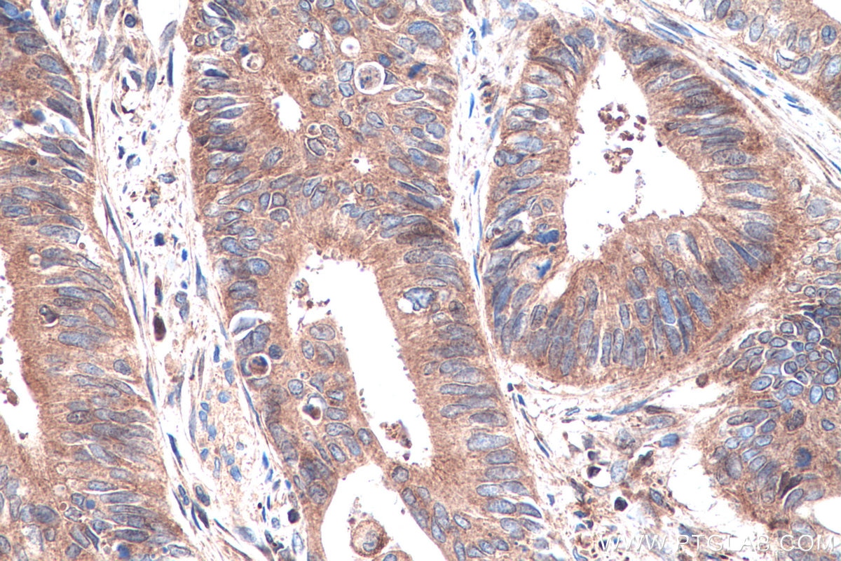 Immunohistochemistry (IHC) staining of human colon cancer tissue using RHOQ/TC10 Monoclonal antibody (67213-1-Ig)