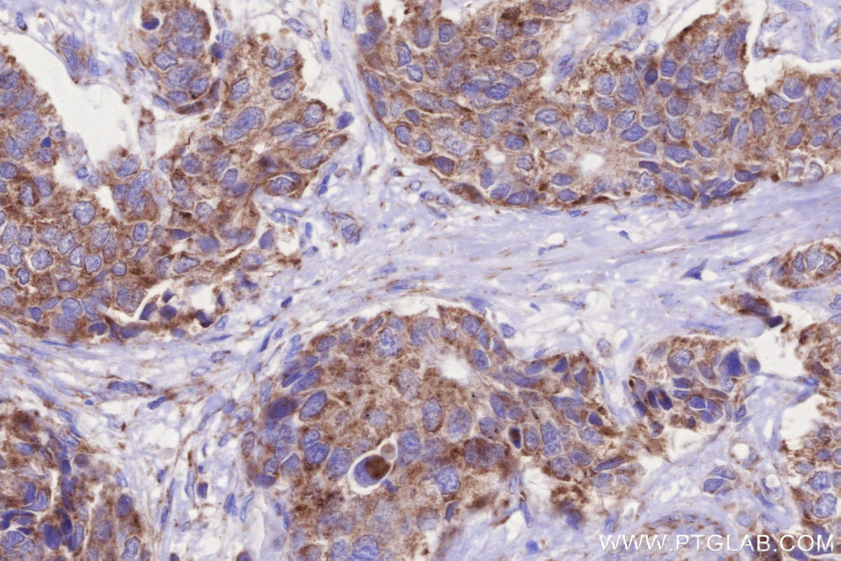 Immunohistochemistry (IHC) staining of human stomach cancer tissue using MIRO1 Recombinant monoclonal antibody (84055-5-RR)