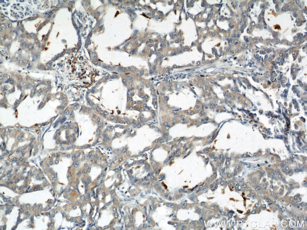 Immunohistochemistry (IHC) staining of human lung cancer tissue using MIRO2 Polyclonal antibody (11237-1-AP)