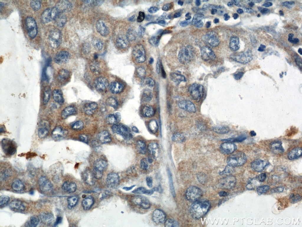Immunohistochemistry (IHC) staining of human lung cancer tissue using MIRO2 Polyclonal antibody (11237-1-AP)