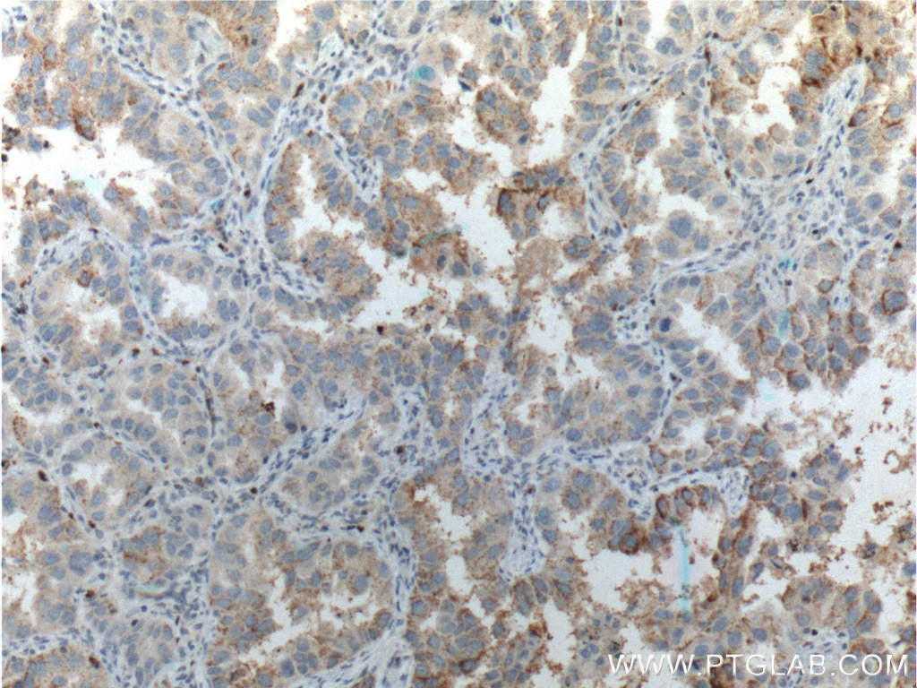 Immunohistochemistry (IHC) staining of human lung cancer tissue using RHOV Polyclonal antibody (26620-1-AP)