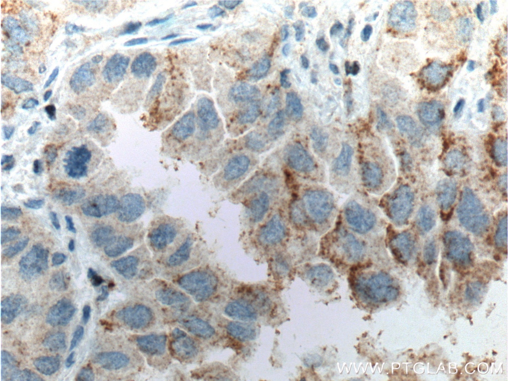 Immunohistochemistry (IHC) staining of human lung cancer tissue using RHOV Polyclonal antibody (26620-1-AP)