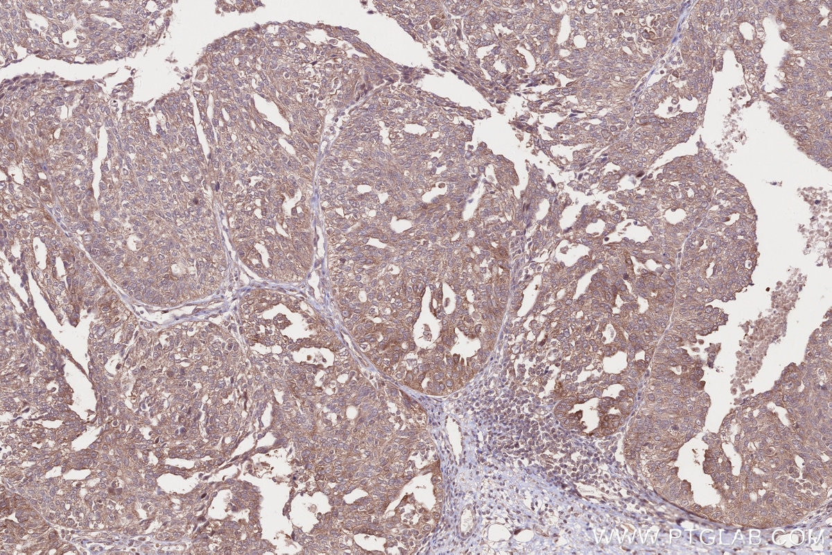 IHC staining of human ovary cancer using 12671-1-AP Immunohistochemistry (IHC) staining of human ovary cancer tissue using RHPN2 Polyclonal antibody (12671-1-AP)