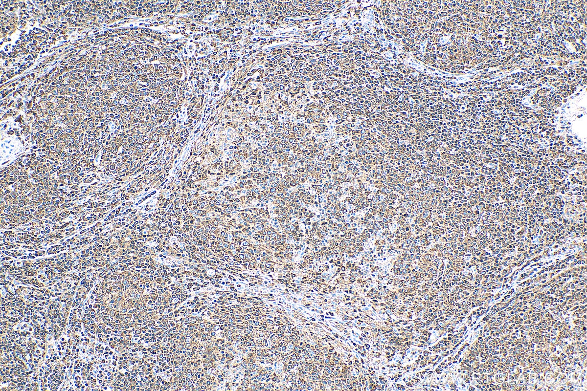 Immunohistochemistry (IHC) staining of human lymphoma tissue using RIAM Polyclonal antibody (13500-1-AP)