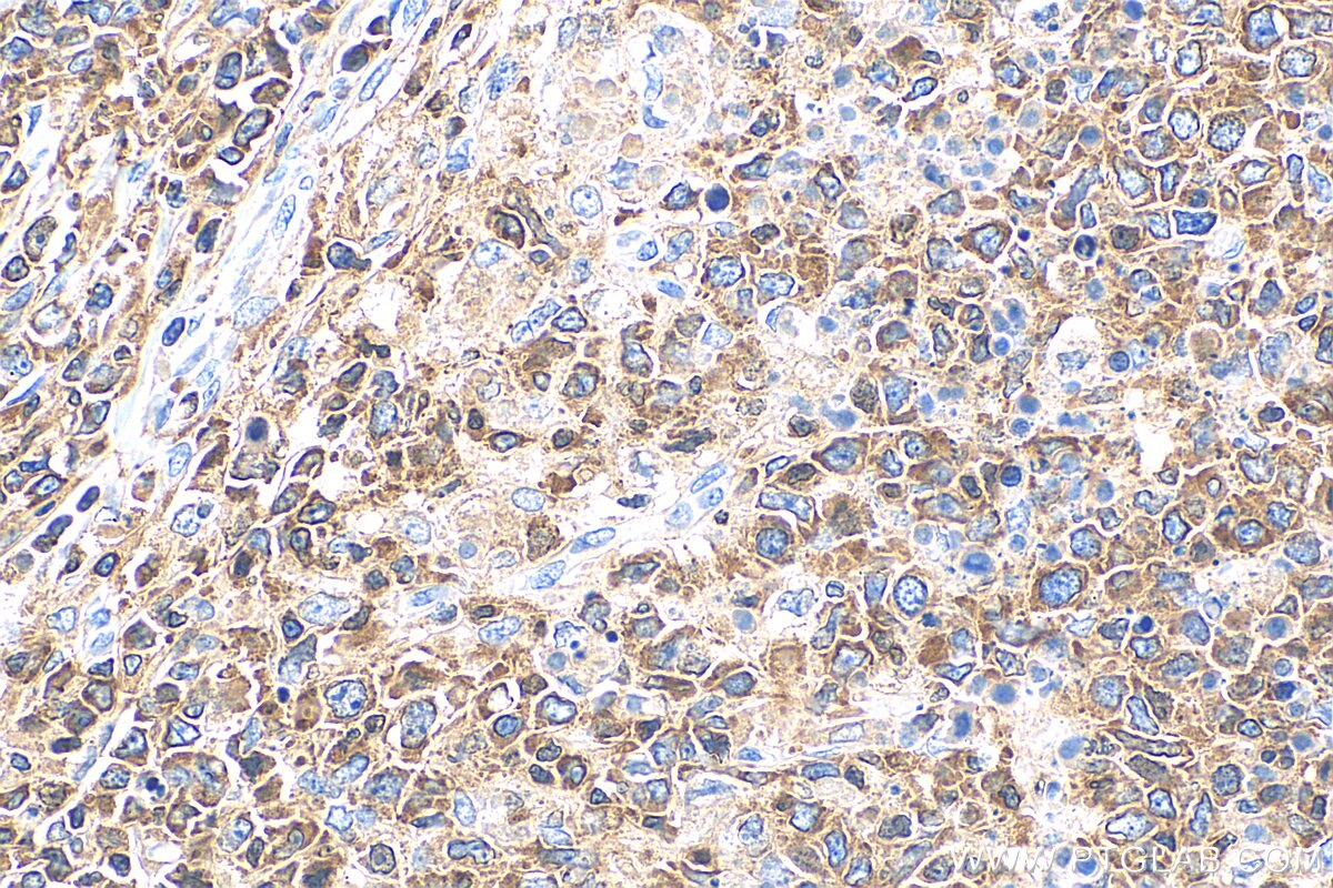 Immunohistochemistry (IHC) staining of human lymphoma tissue using RIAM Polyclonal antibody (13500-1-AP)