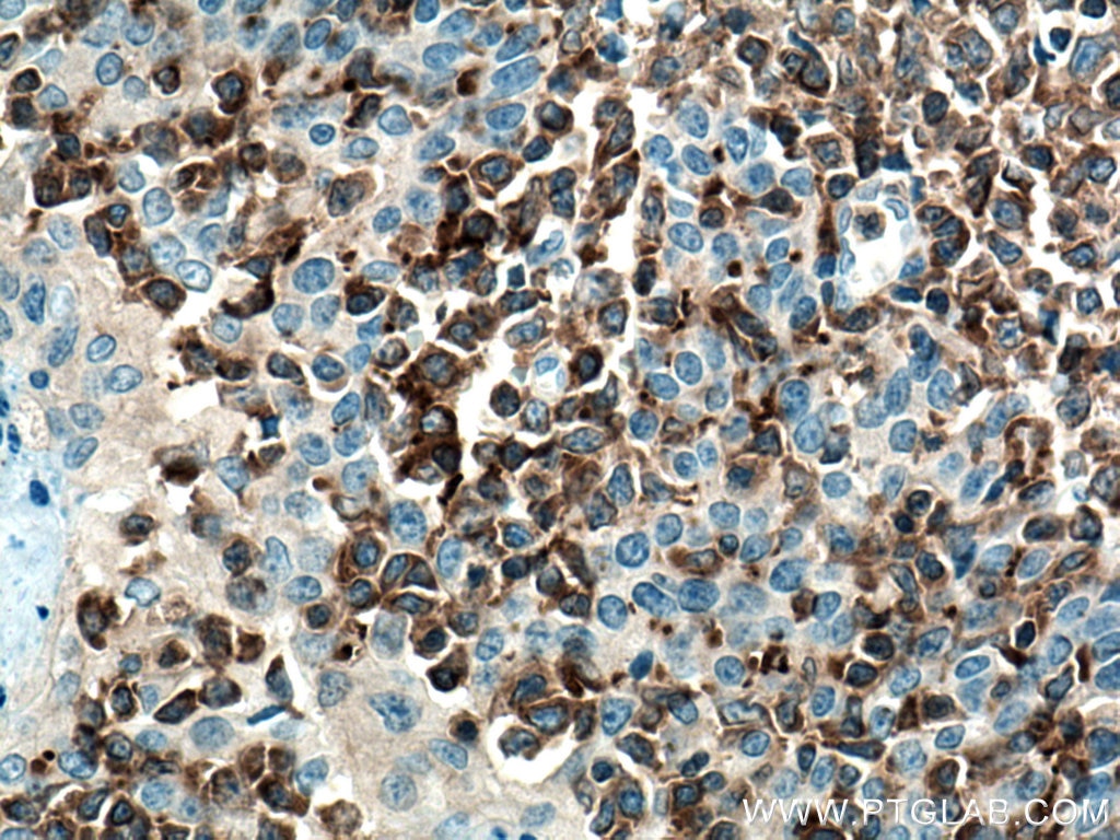 Immunohistochemistry (IHC) staining of human tonsillitis tissue using RIAM Monoclonal antibody (67143-1-Ig)