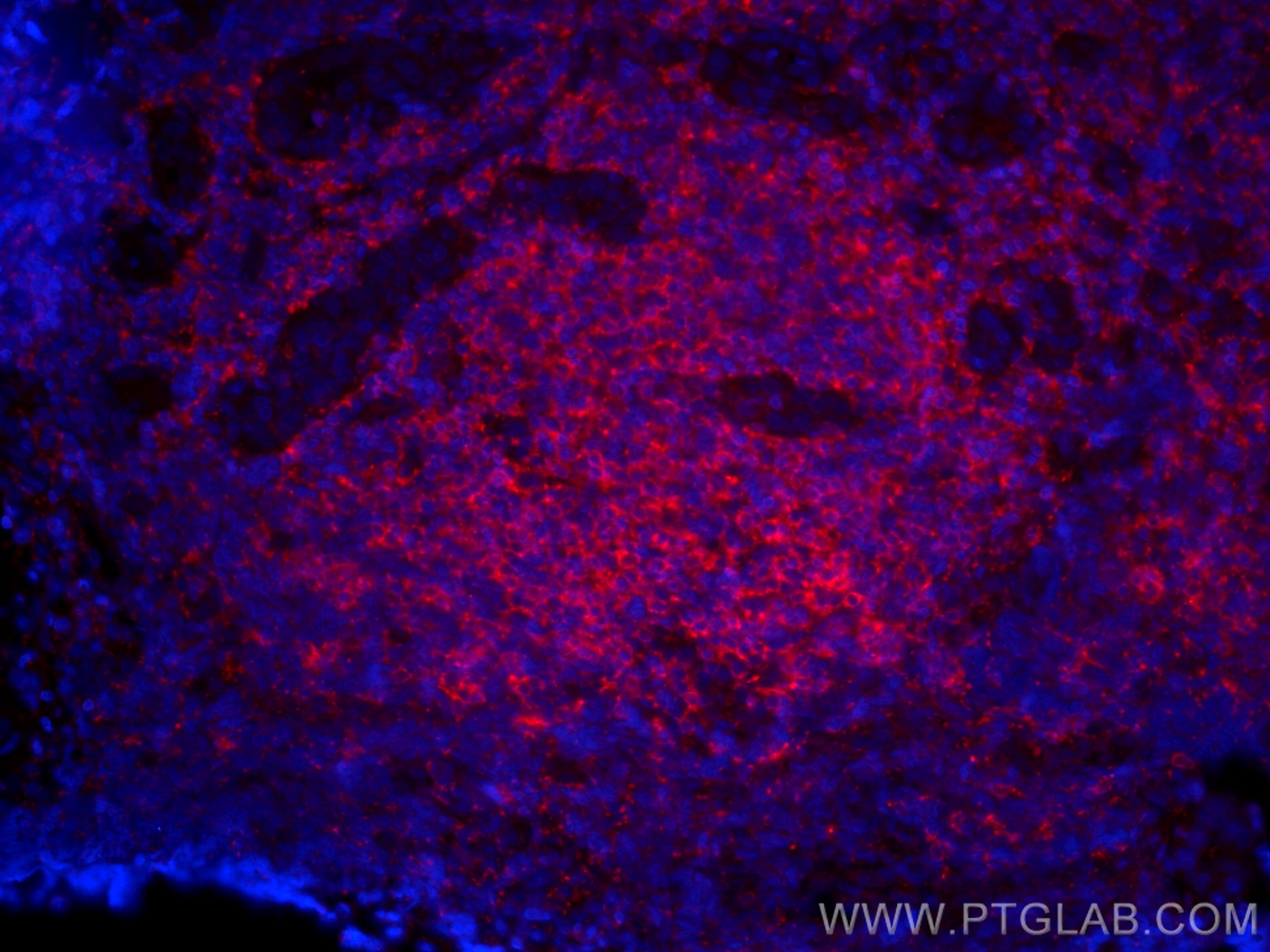 Immunofluorescence (IF) / fluorescent staining of human tonsillitis tissue using CoraLite®594-conjugated RIAM,APBB1IP Monoclonal an (CL594-67143)