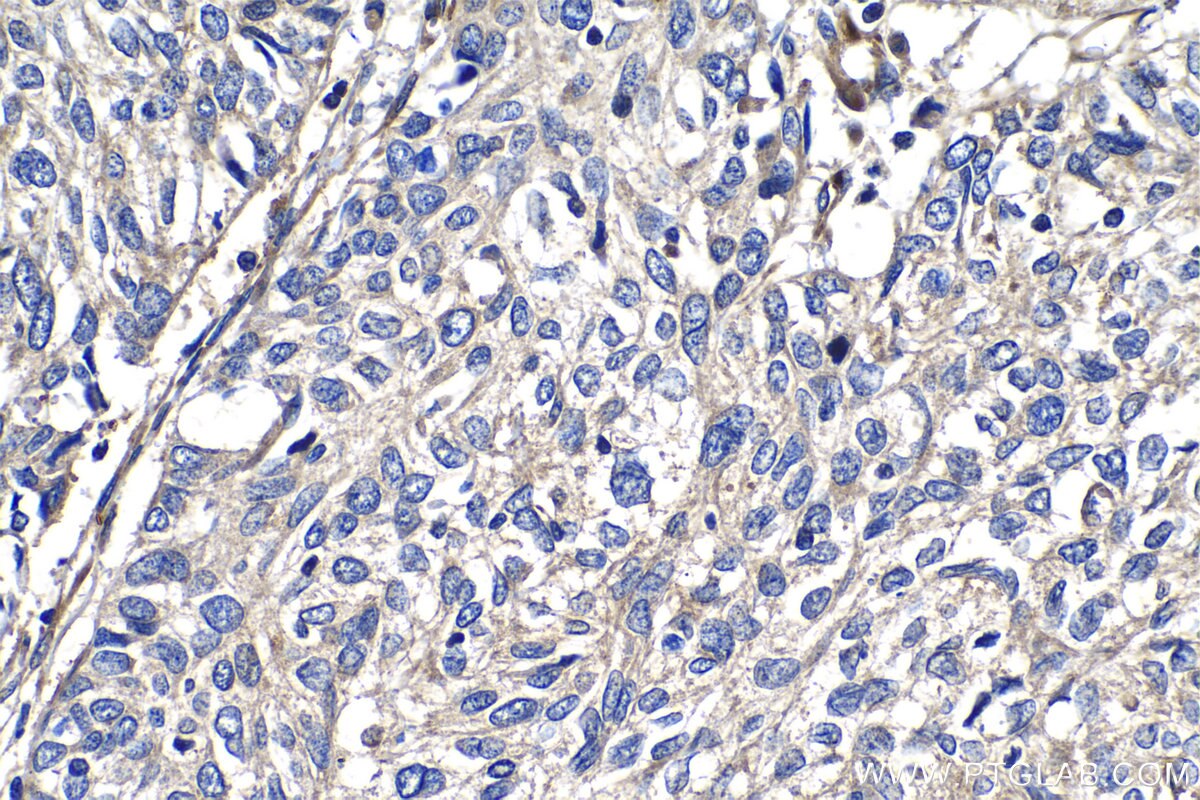 Immunohistochemistry (IHC) staining of human cervical cancer tissue using RIBC2 Polyclonal antibody (15272-1-AP)