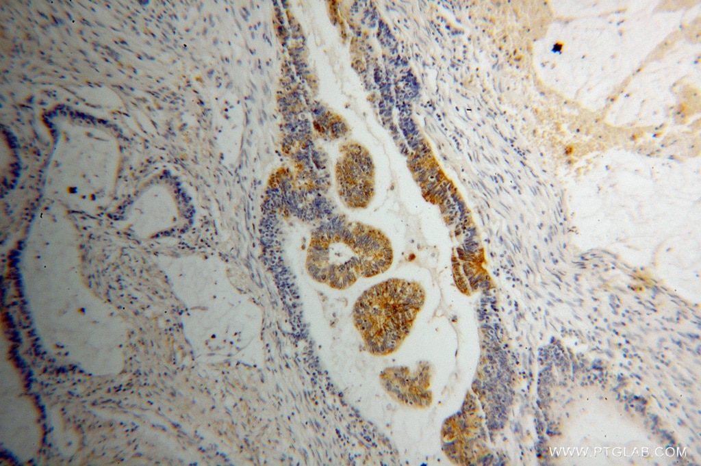 IHC staining of human colon cancer using 15272-1-AP