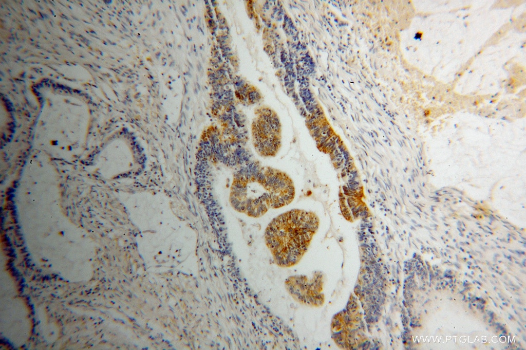 Immunohistochemistry (IHC) staining of human colon cancer tissue using RIBC2 Polyclonal antibody (15272-1-AP)