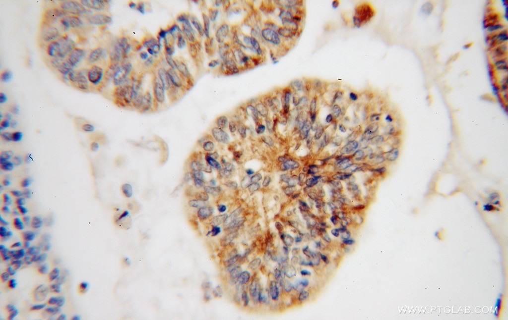 Immunohistochemistry (IHC) staining of human colon cancer tissue using RIBC2 Polyclonal antibody (15272-1-AP)