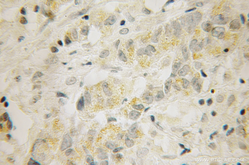 Immunohistochemistry (IHC) staining of human prostate cancer tissue using RIC3 Polyclonal antibody (12779-1-AP)