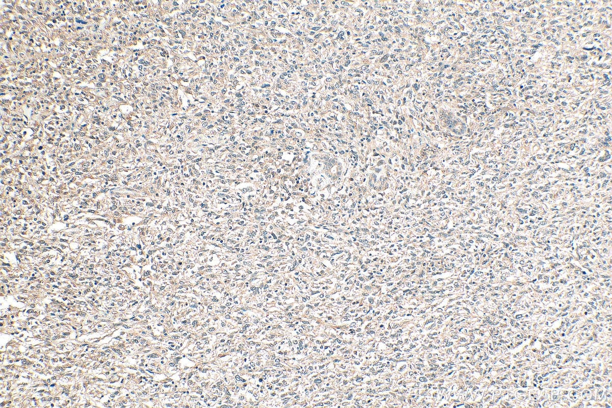 Immunohistochemistry (IHC) staining of human pancreas cancer tissue using RIC8A Polyclonal antibody (11138-1-AP)