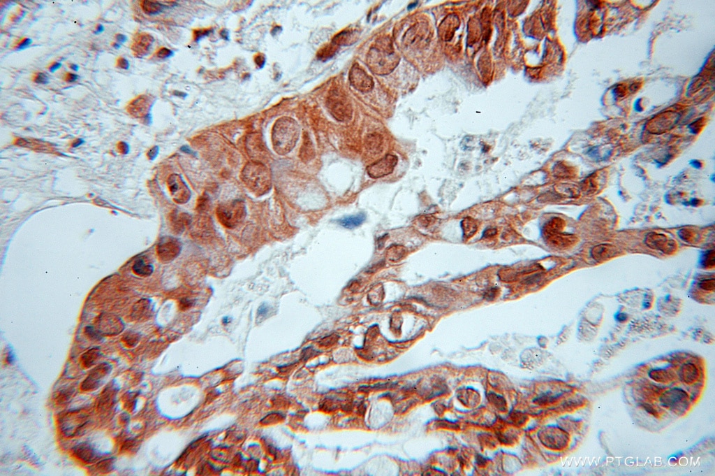 IHC staining of human pancreas cancer using 11138-1-AP