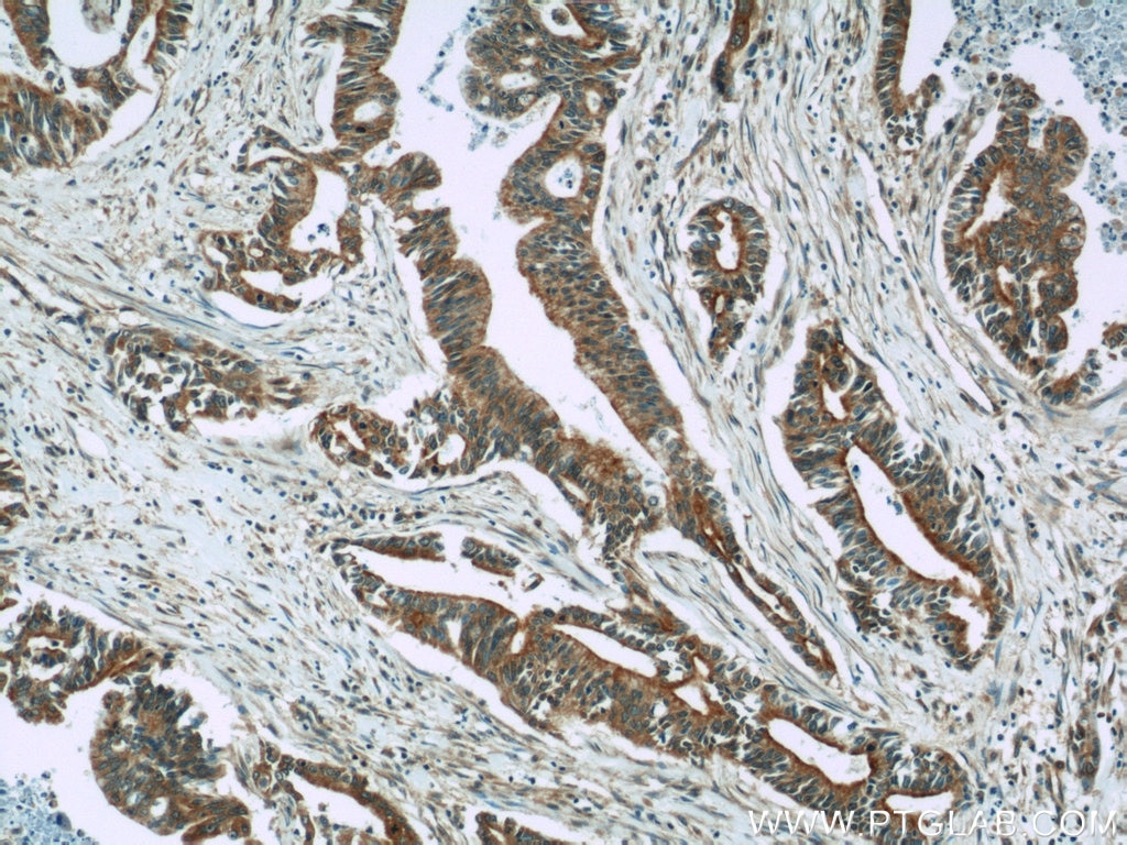 Immunohistochemistry (IHC) staining of human pancreas cancer tissue using RIC8A Polyclonal antibody (18707-1-AP)