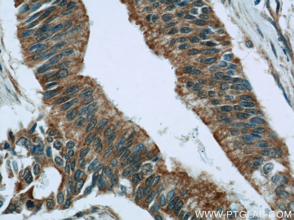 Immunohistochemistry (IHC) staining of human pancreas cancer tissue using RIC8A Polyclonal antibody (18707-1-AP)