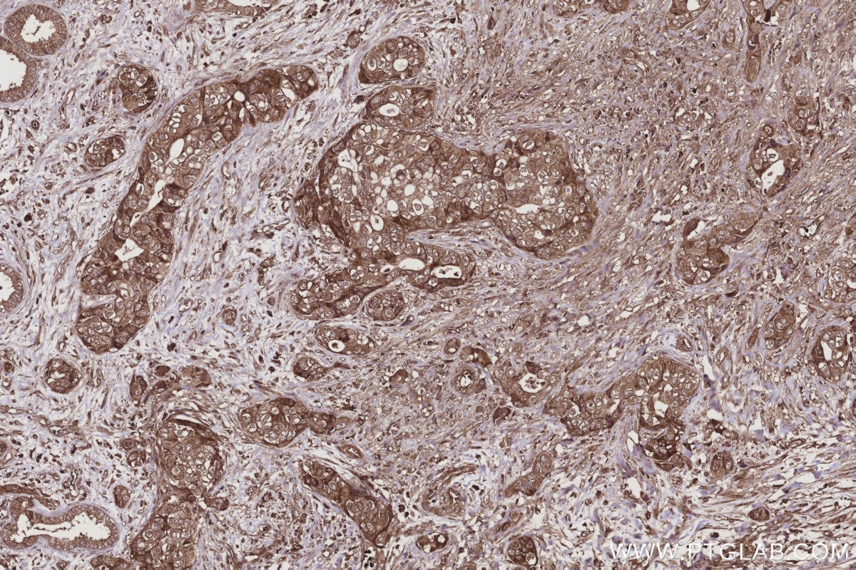 IHC staining of human pancreas cancer using 66625-1-Ig Immunohistochemistry (IHC) staining of human pancreas cancer tissue using RIC8A Monoclonal antibody (66625-1-Ig)