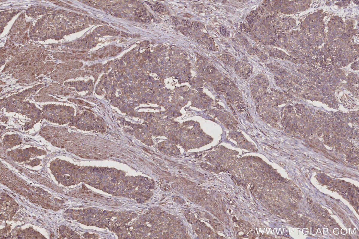 IHC staining of human stomach cancer using 66625-1-Ig Immunohistochemistry (IHC) staining of human stomach cancer tissue using RIC8A Monoclonal antibody (66625-1-Ig)