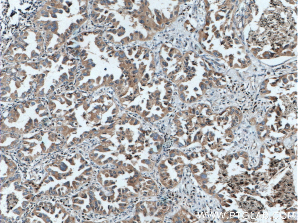 Immunohistochemistry (IHC) staining of human lung cancer tissue using RICTOR Polyclonal antibody (27248-1-AP)
