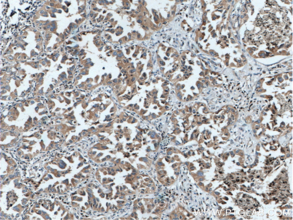 Immunohistochemistry (IHC) staining of human lung cancer tissue using RICTOR Polyclonal antibody (27248-1-AP)