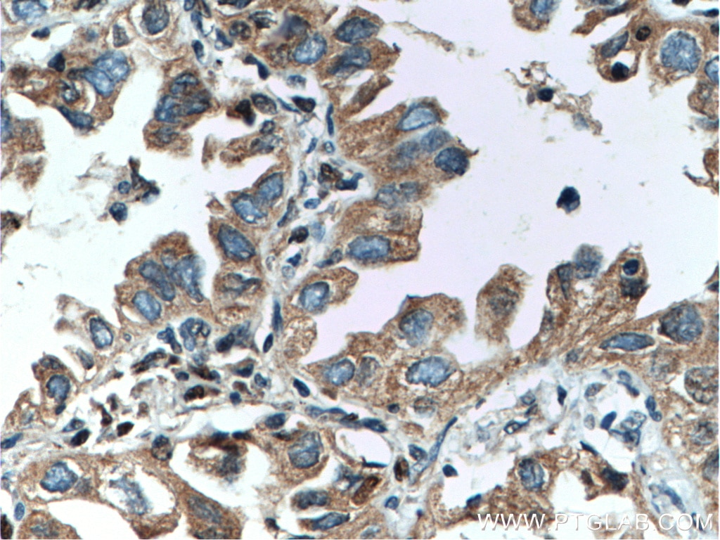 Immunohistochemistry (IHC) staining of human lung cancer tissue using RICTOR Polyclonal antibody (27248-1-AP)