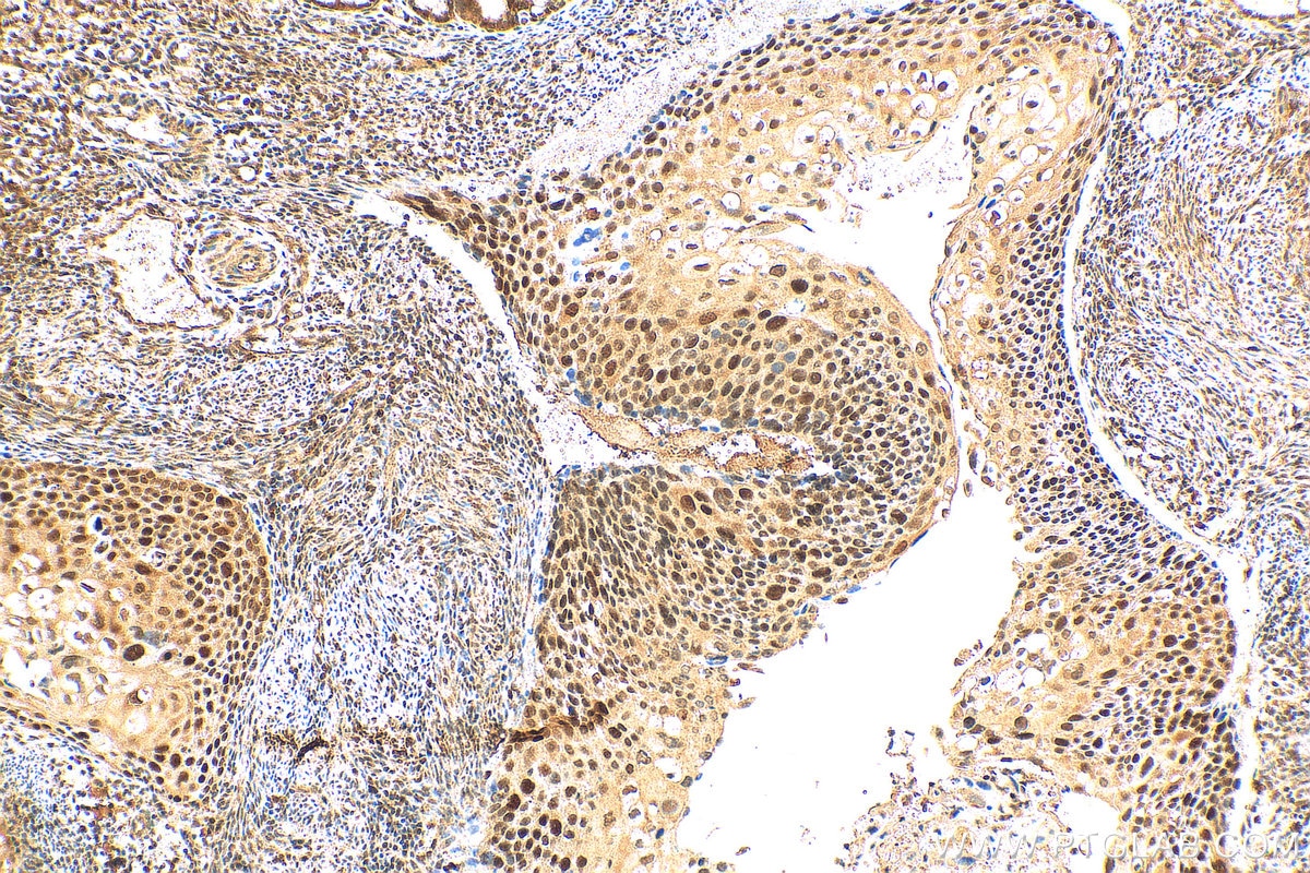 Immunohistochemistry (IHC) staining of human cervical cancer tissue using RIF1 Polyclonal antibody (30119-1-AP)