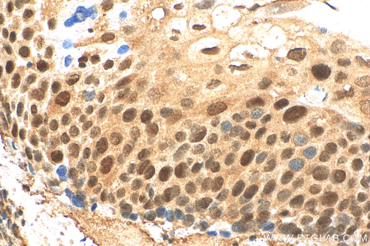 Immunohistochemistry (IHC) staining of human cervical cancer tissue using RIF1 Polyclonal antibody (30119-1-AP)