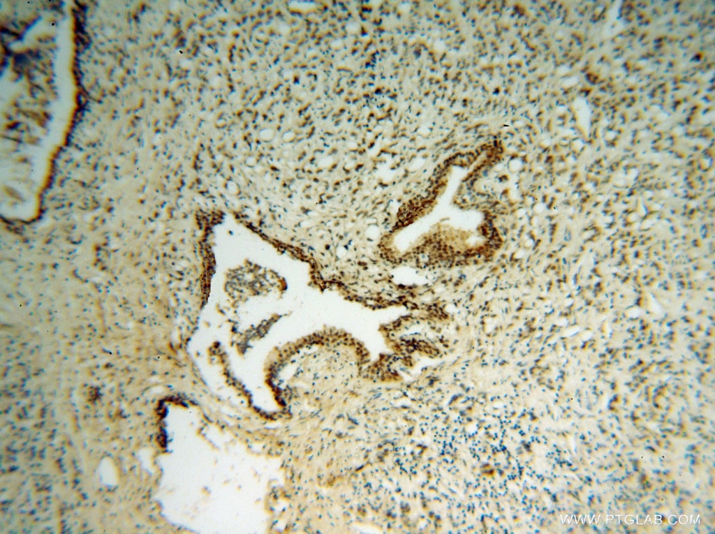 IHC staining of human prostate cancer using 15037-1-AP