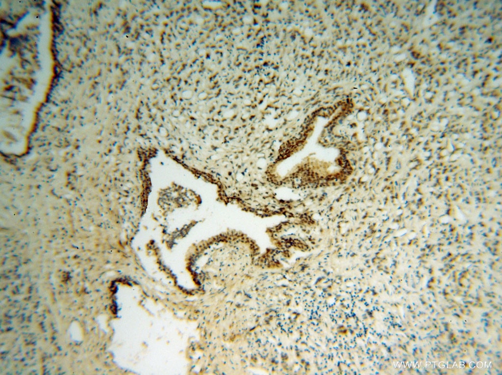 Immunohistochemistry (IHC) staining of human prostate cancer tissue using RING1 Polyclonal antibody (15037-1-AP)