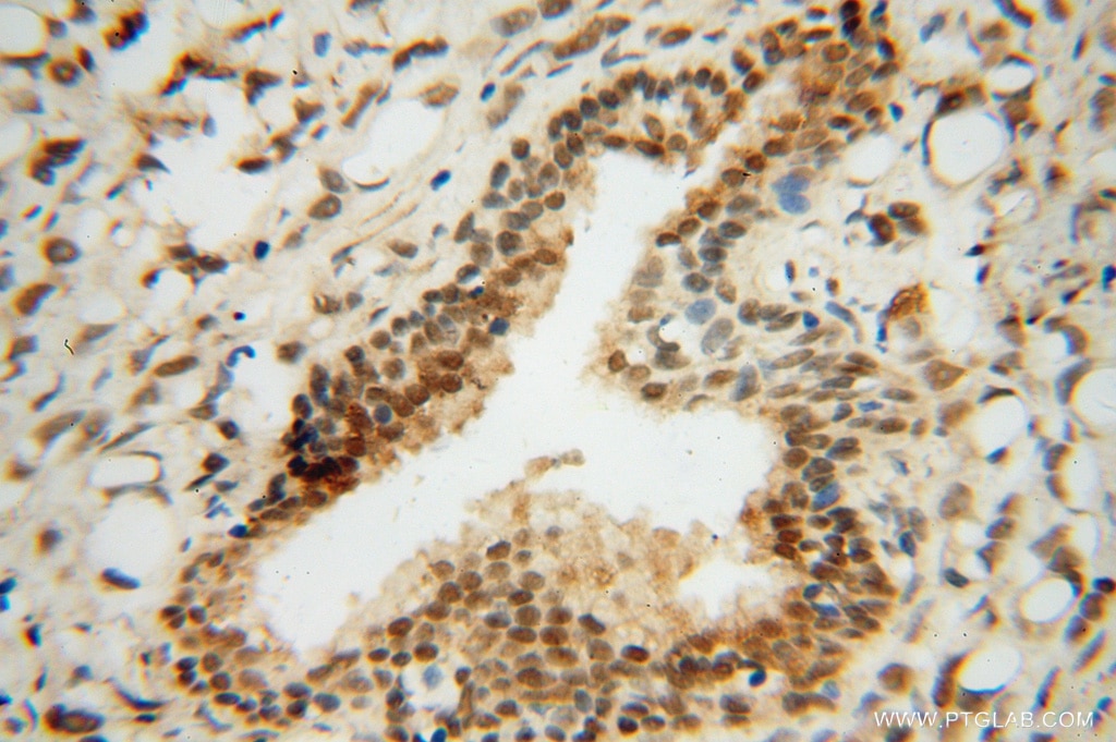 Immunohistochemistry (IHC) staining of human prostate cancer tissue using RING1 Polyclonal antibody (15037-1-AP)