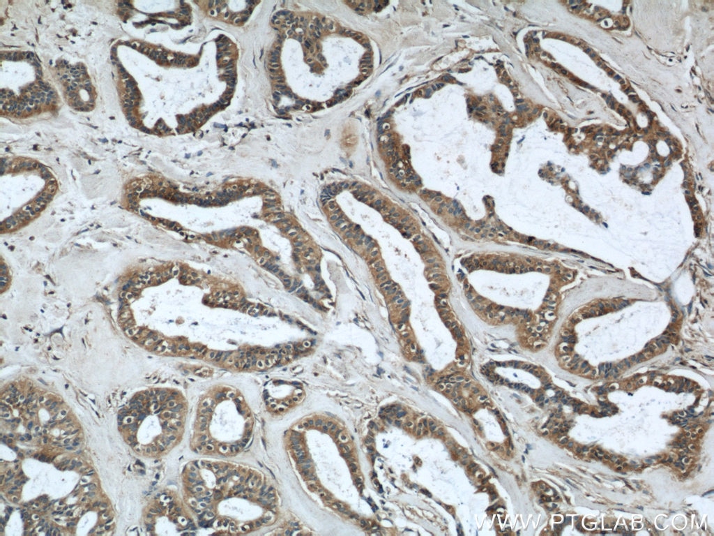 Immunohistochemistry (IHC) staining of human breast cancer tissue using RINT1 Polyclonal antibody (14567-1-AP)