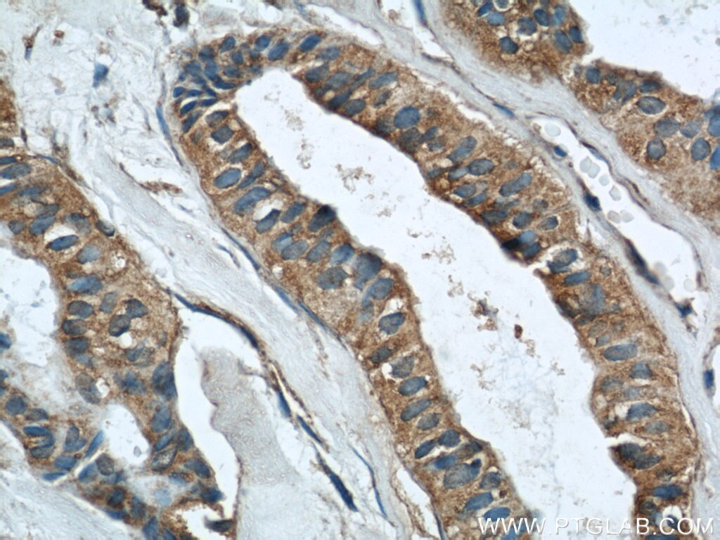 Immunohistochemistry (IHC) staining of human breast cancer tissue using RINT1 Polyclonal antibody (14567-1-AP)