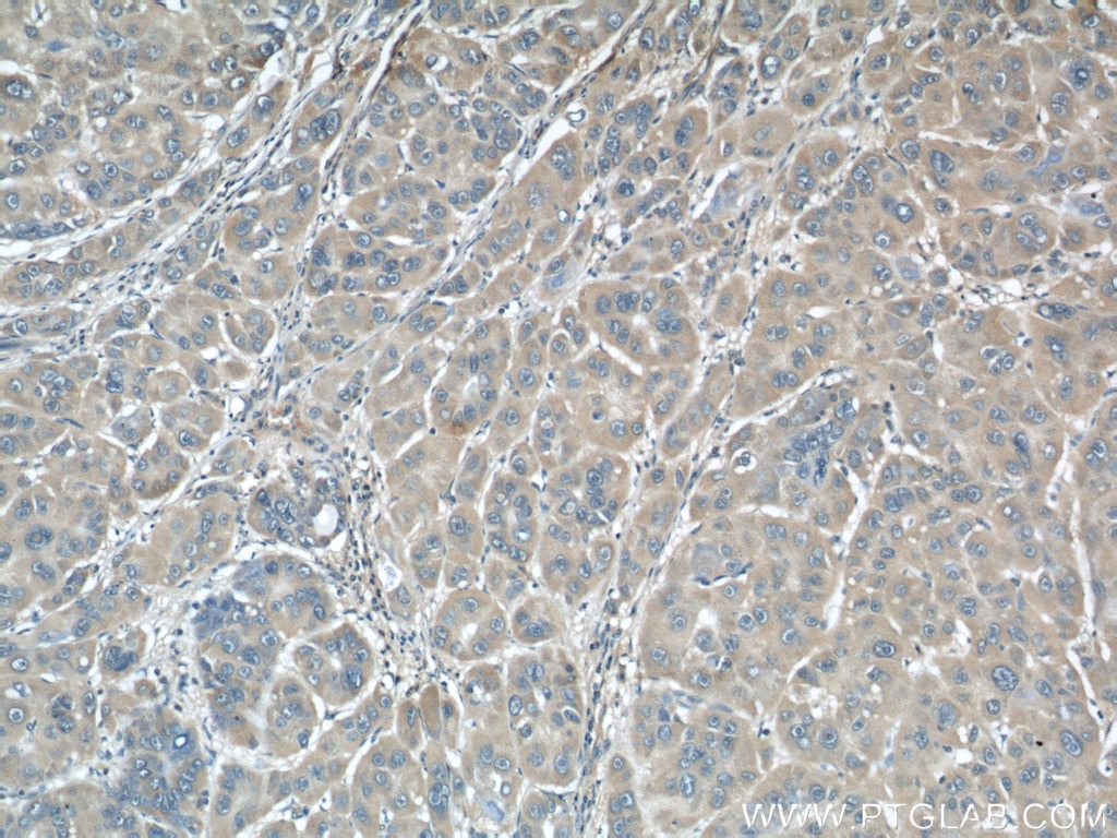 Immunohistochemistry (IHC) staining of human liver cancer tissue using RINT1 Polyclonal antibody (14567-1-AP)