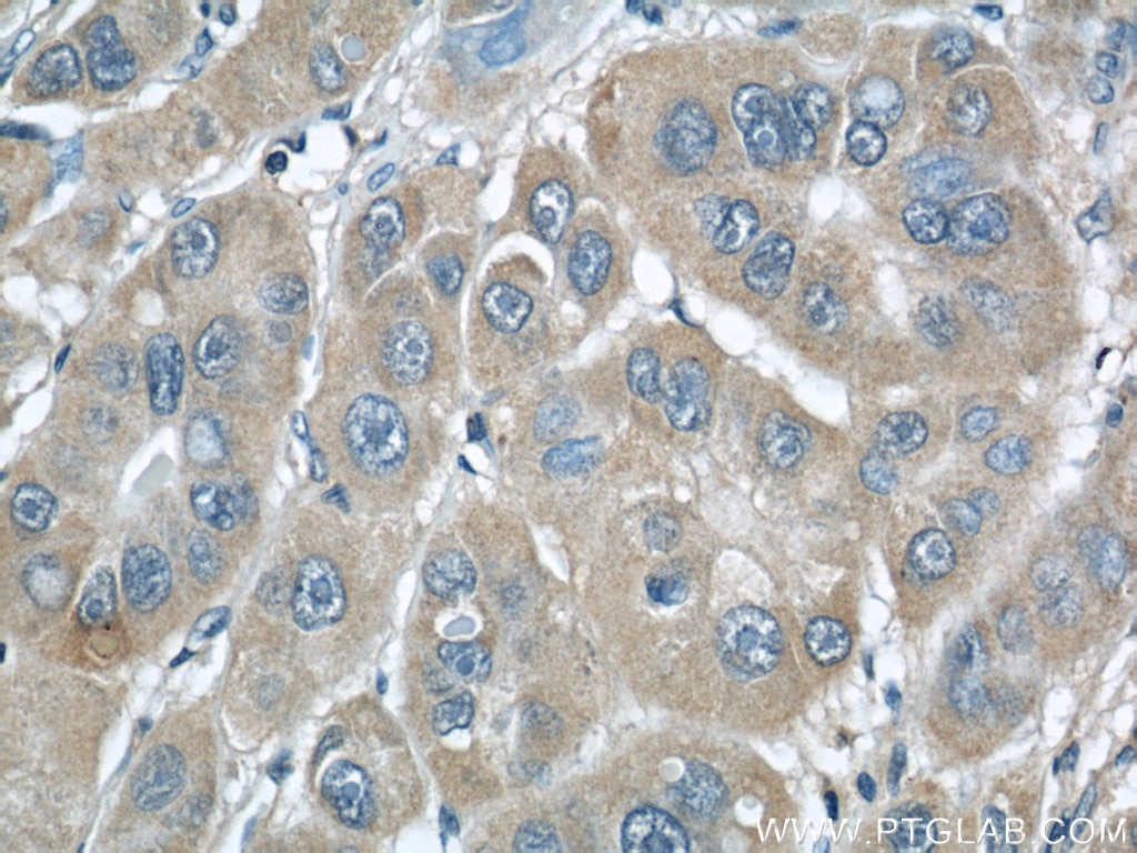 Immunohistochemistry (IHC) staining of human liver cancer tissue using RINT1 Polyclonal antibody (14567-1-AP)