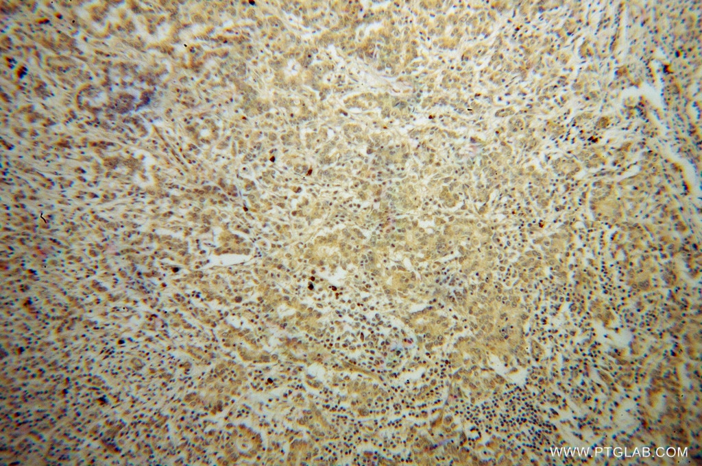 Immunohistochemistry (IHC) staining of human breast cancer tissue using RINT1 Polyclonal antibody (14567-1-AP)