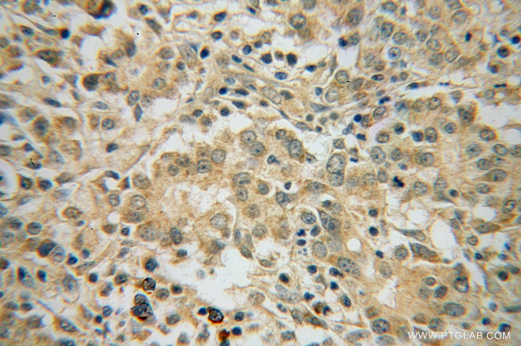 Immunohistochemistry (IHC) staining of human breast cancer tissue using RINT1 Polyclonal antibody (14567-1-AP)