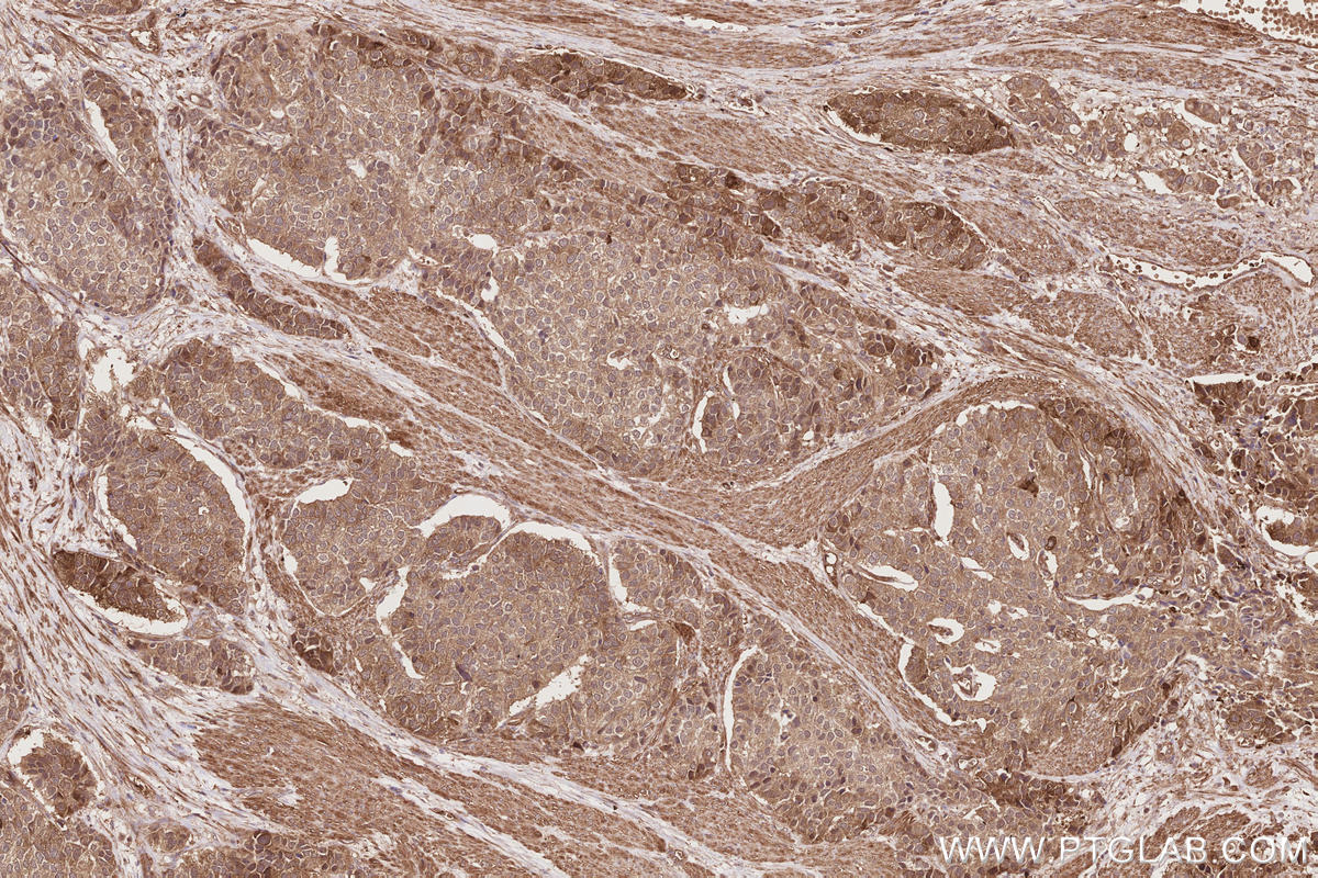 Immunohistochemistry (IHC) staining of human stomach cancer tissue using RIOK1 Polyclonal antibody (17222-1-AP)
