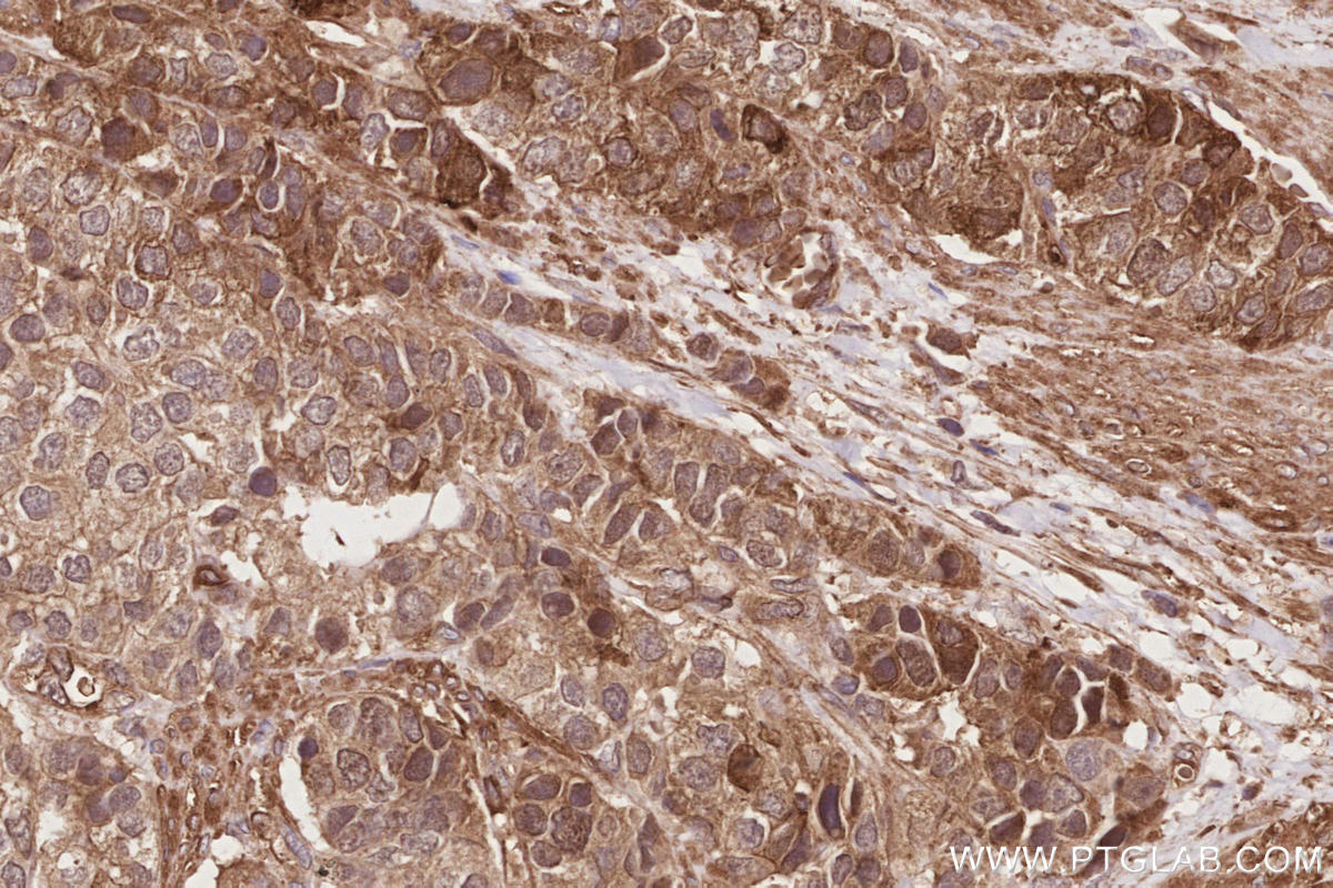 Immunohistochemistry (IHC) staining of human stomach cancer tissue using RIOK1 Polyclonal antibody (17222-1-AP)