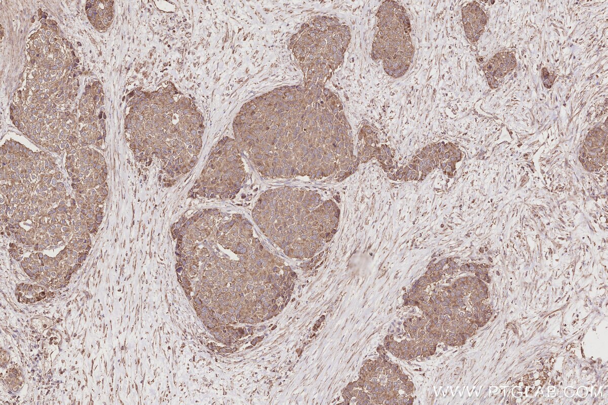 IHC staining of human stomach cancer using 17410-1-AP Immunohistochemistry (IHC) staining of human stomach cancer tissue using RIOK2 Polyclonal antibody (17410-1-AP)