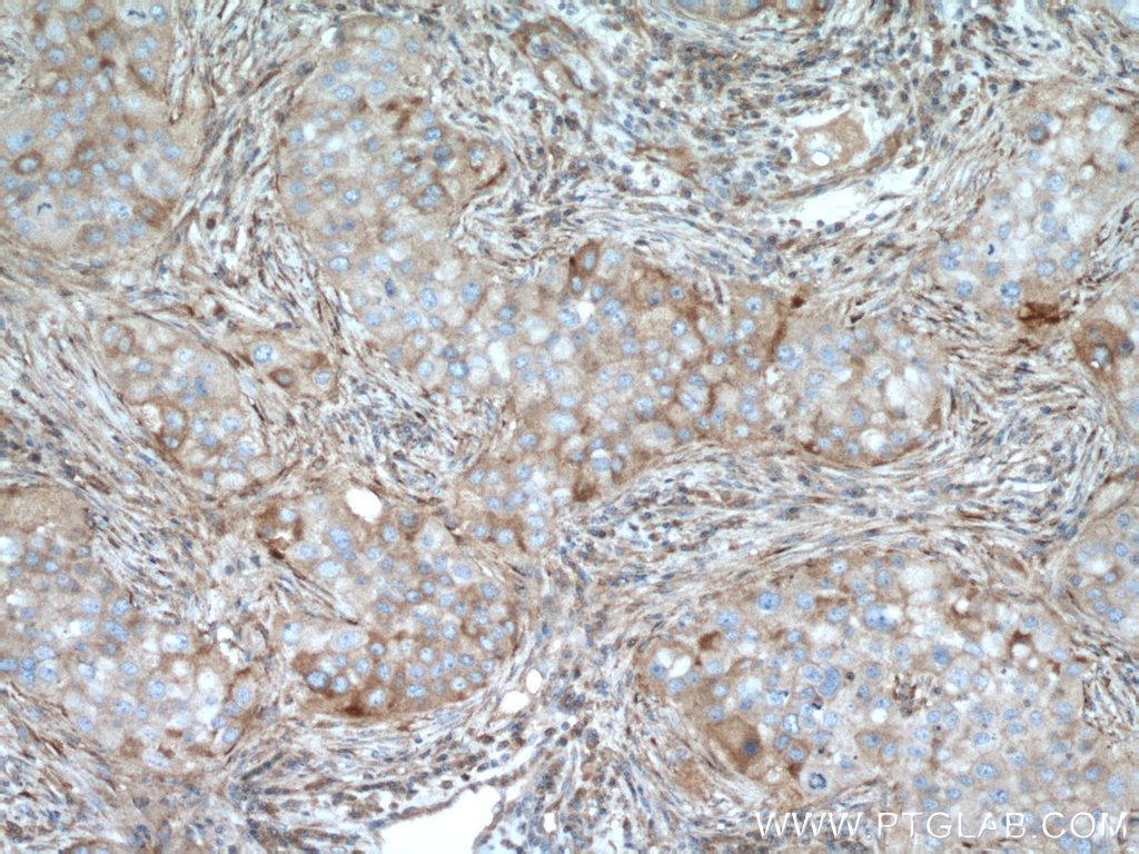 Immunohistochemistry (IHC) staining of human breast cancer tissue using RIOK3 Polyclonal antibody (13593-1-AP)