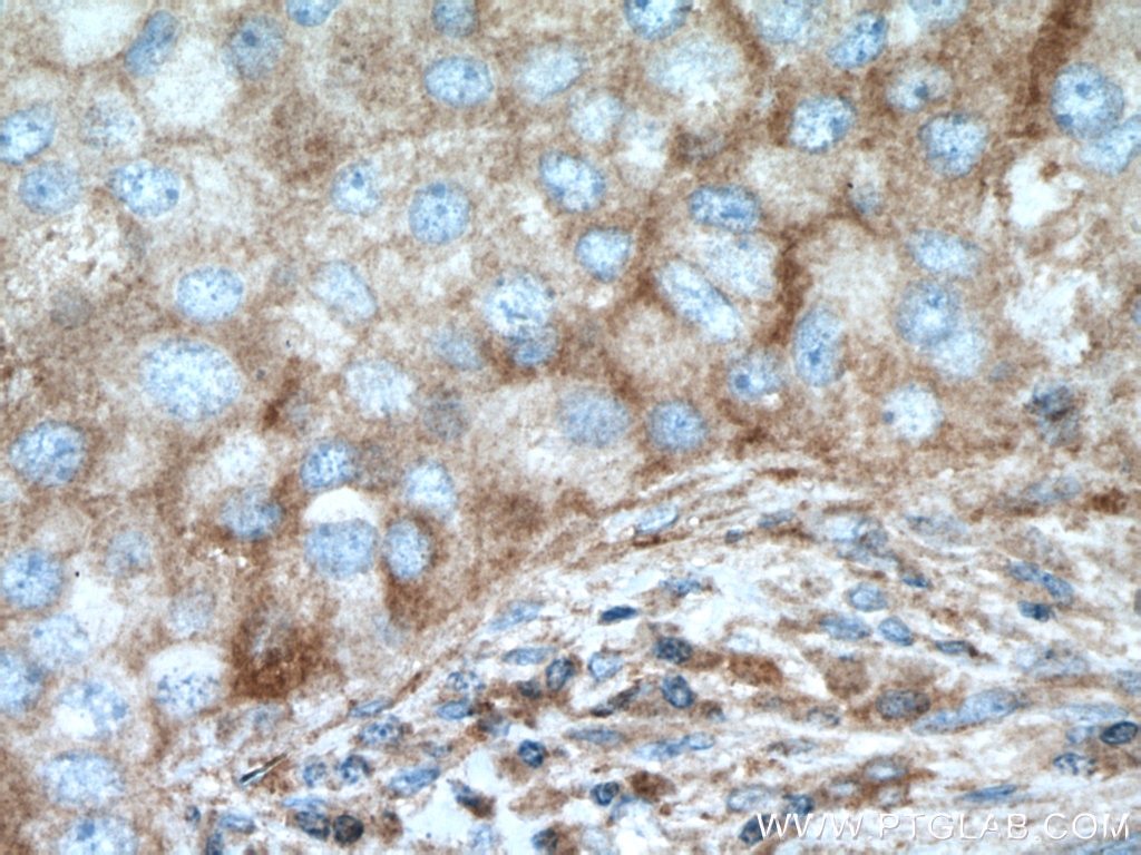Immunohistochemistry (IHC) staining of human breast cancer tissue using RIOK3 Polyclonal antibody (13593-1-AP)