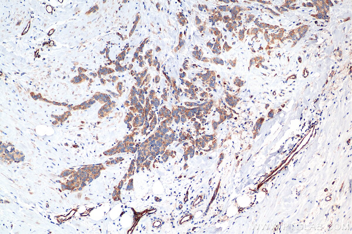 Immunohistochemical analysis of paraffin-embedded human breast cancer tissue slide using 85449-5-RR (RIOK3 antibody) at dilution of 1:2000 (under 10x lens). Heat mediated antigen retrieval with Tris-EDTA buffer (pH 9.0). Immunohistochemistry (IHC) staining of human breast cancer tissue using RIOK3 Recombinant monoclonal antibody (85449-5-RR)