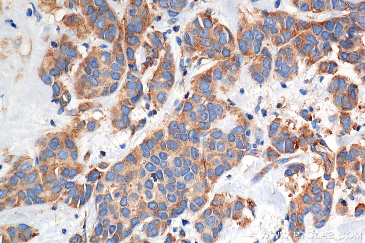 Immunohistochemical analysis of paraffin-embedded human breast cancer tissue slide using 85449-5-RR (RIOK3 antibody) at dilution of 1:2000 (under 40x lens). Heat mediated antigen retrieval with Tris-EDTA buffer (pH 9.0). Immunohistochemistry (IHC) staining of human breast cancer tissue using RIOK3 Recombinant monoclonal antibody (85449-5-RR)